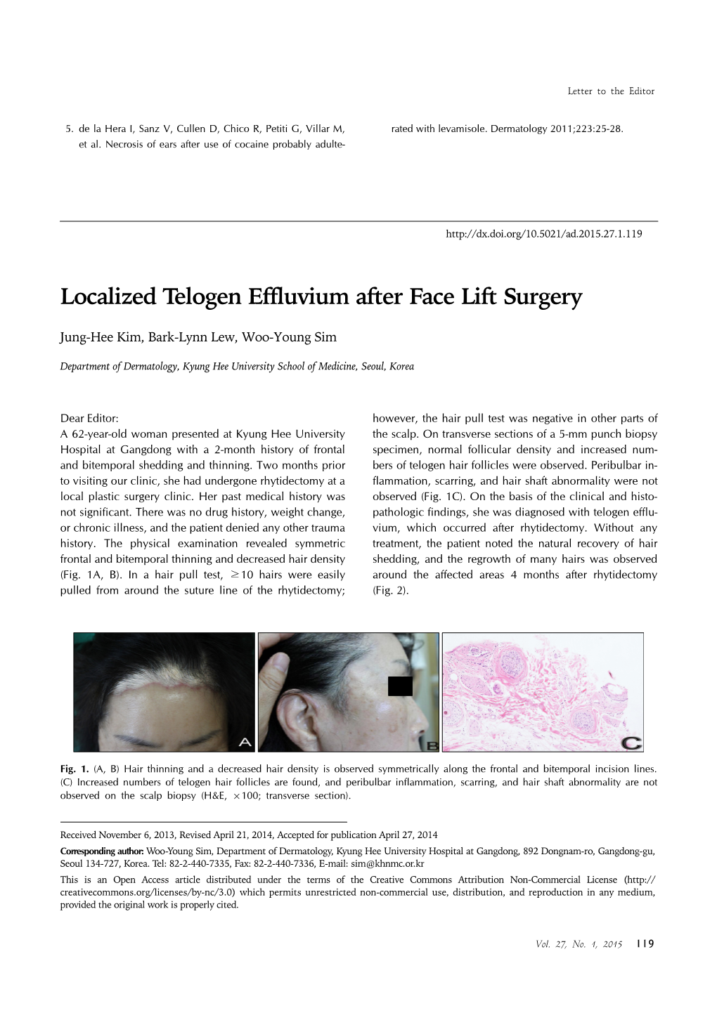 Localized Telogen Effluvium After Face Lift Surgery