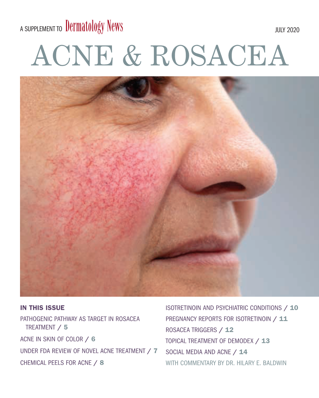 Acne & Rosacea