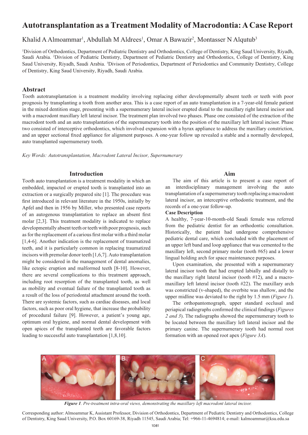 Autotransplantation As a Treatment Modality of Macrodontia: a Case Report