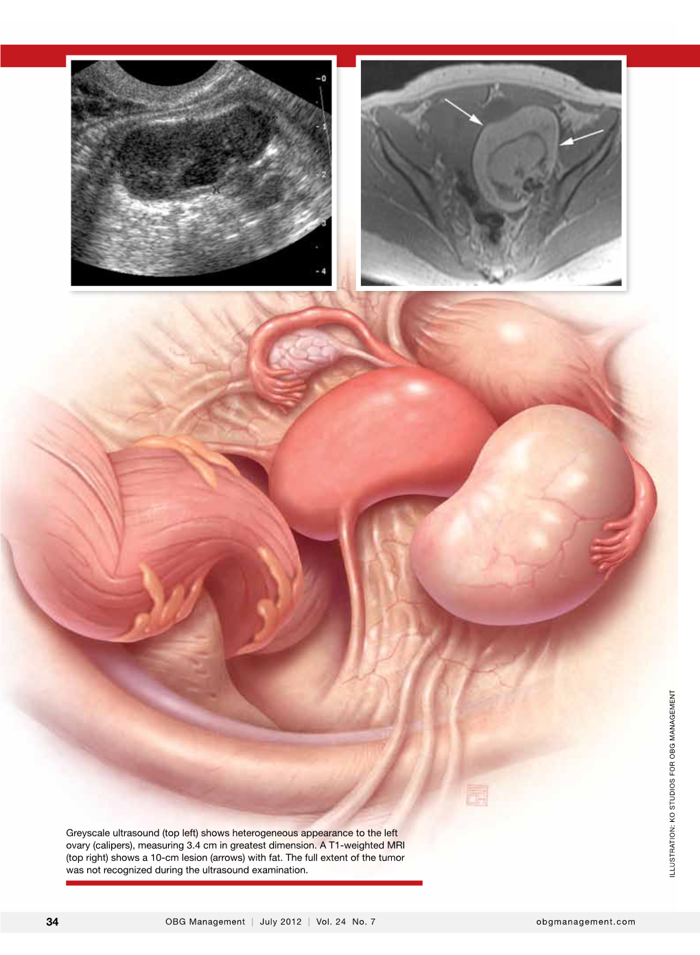 Shows Heterogeneous Appearance to the Left Ovary (Calipers), Measuring 3.4 Cm in Greatest Dimension