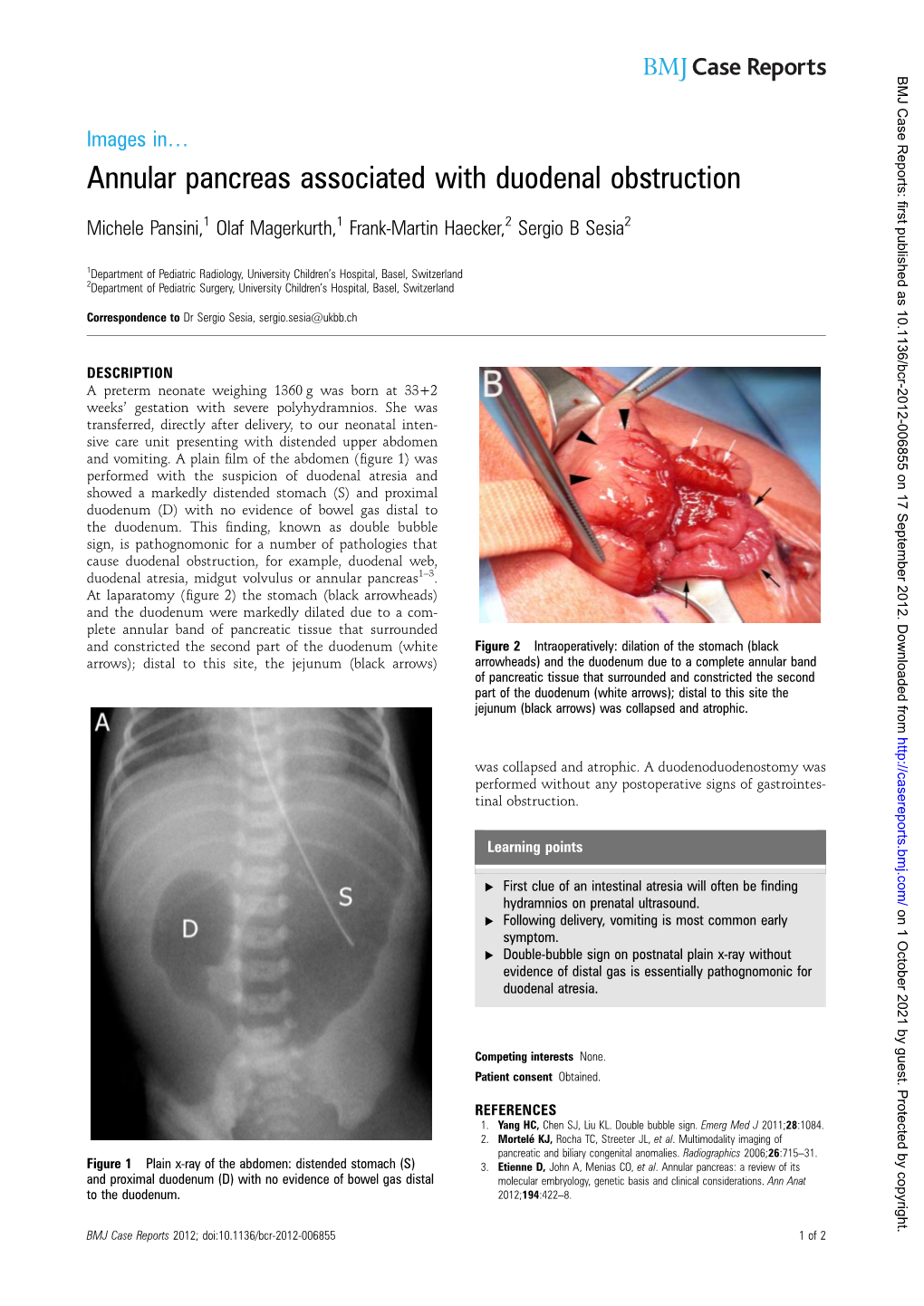 Annular Pancreas Associated with Duodenal Obstruction