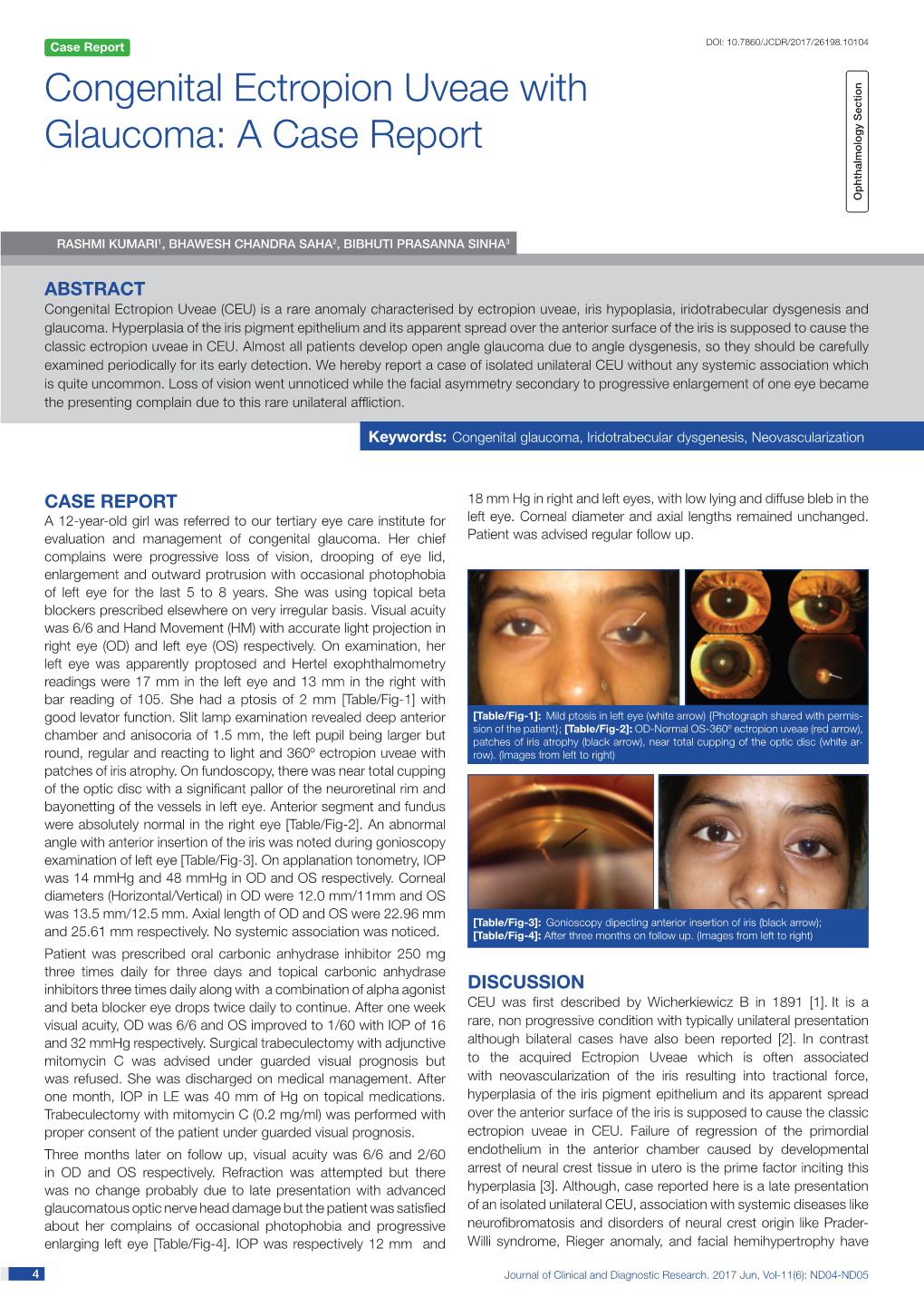 Congenital Ectropion Uveae with Glaucoma: a Case Report Ophthalmology Section