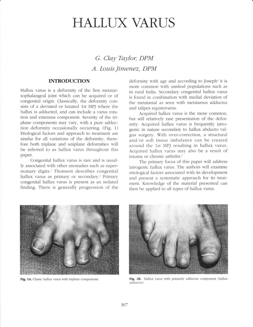 Hallux Varus Is a Deformity of the First Metatar- in Rural Inclia