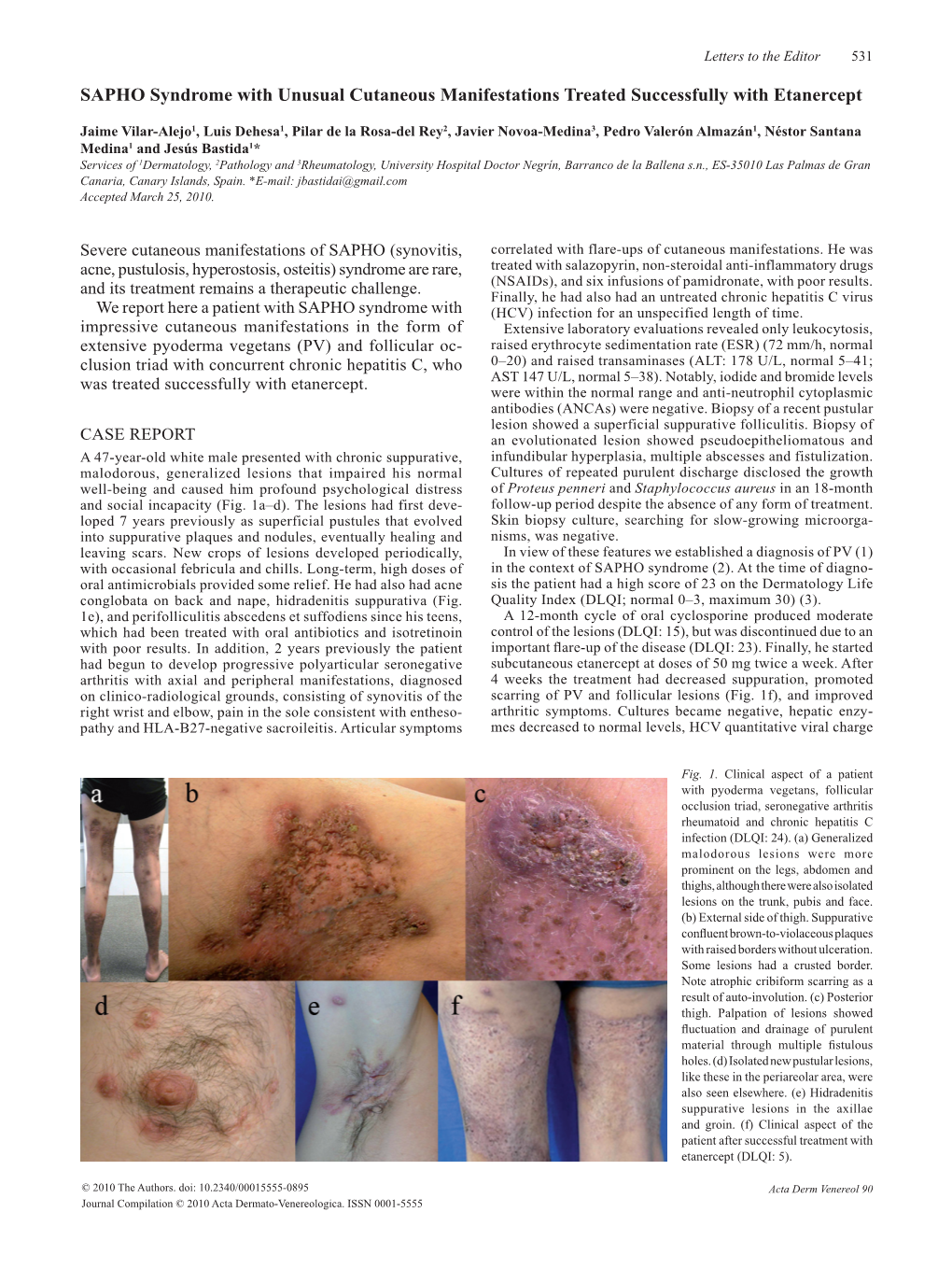 SAPHO Syndrome with Unusual Cutaneous Manifestations Treated Successfully with Etanercept