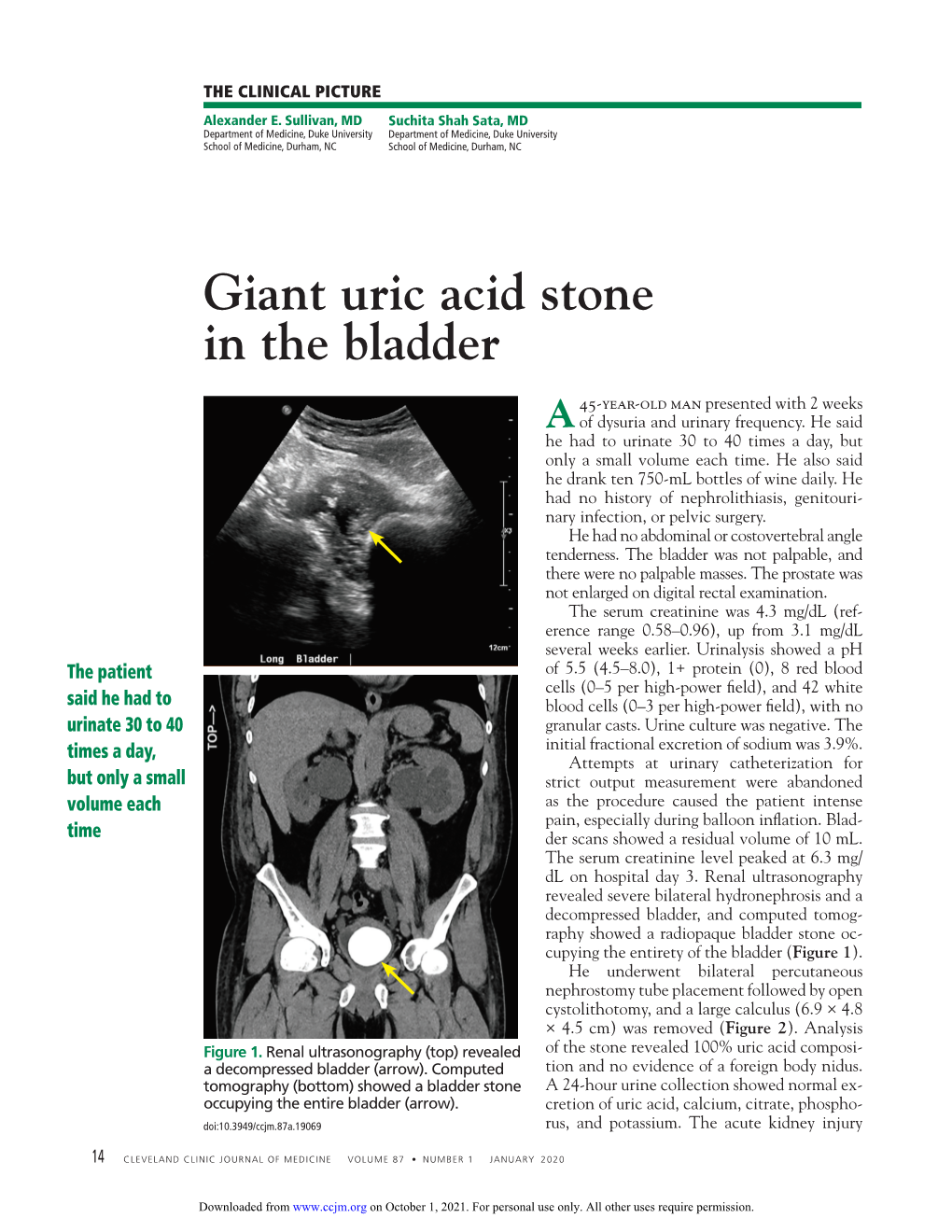 Giant Uric Acid Stone in the Bladder