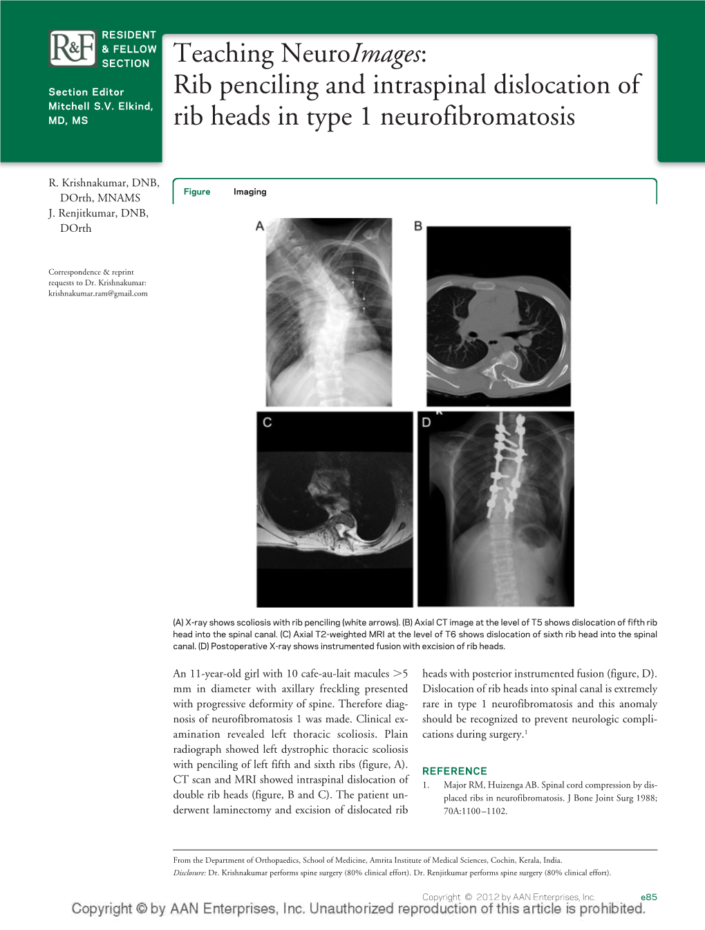 Rib Penciling and Intraspinal Dislocation of Rib Heads in Type 1 Neurofibromatosis R