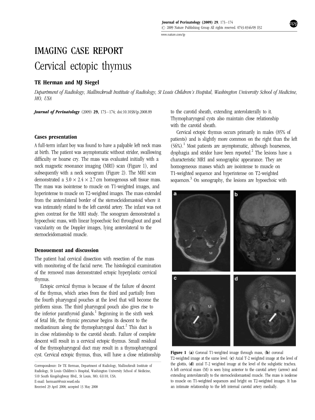 Cervical Ectopic Thymus