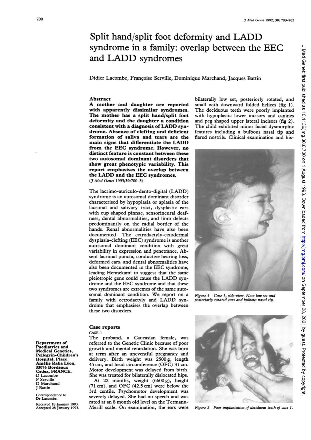 Split Hand/Split Foot Deformity and LADD Syndrome in a Family: Overlap Between the EEC J Med Genet: First Published As 10.1136/Jmg.30.8.700 on 1 August 1993