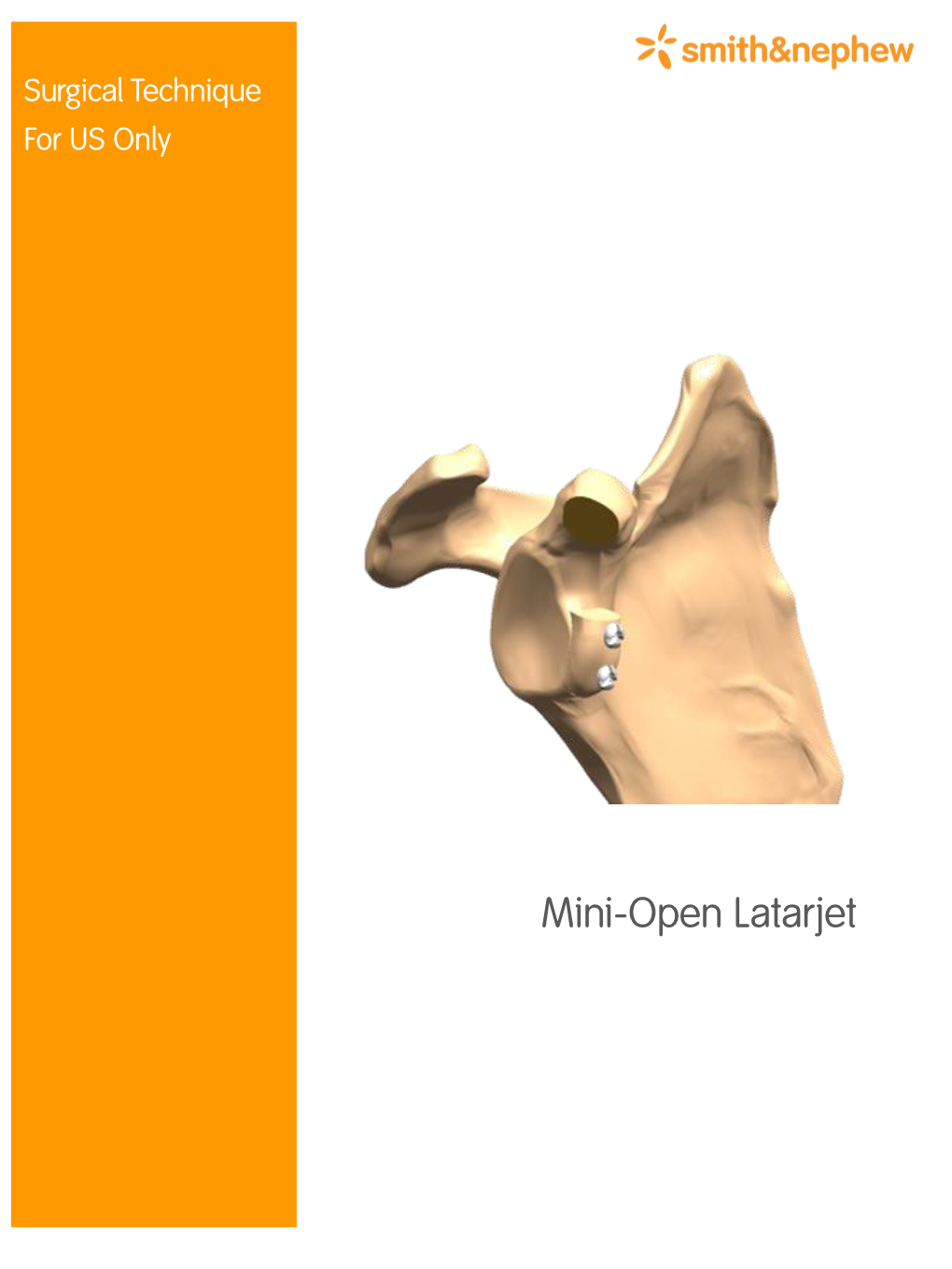 Mini-Open Latarjet Mini-Open Latarjet Technique Guide