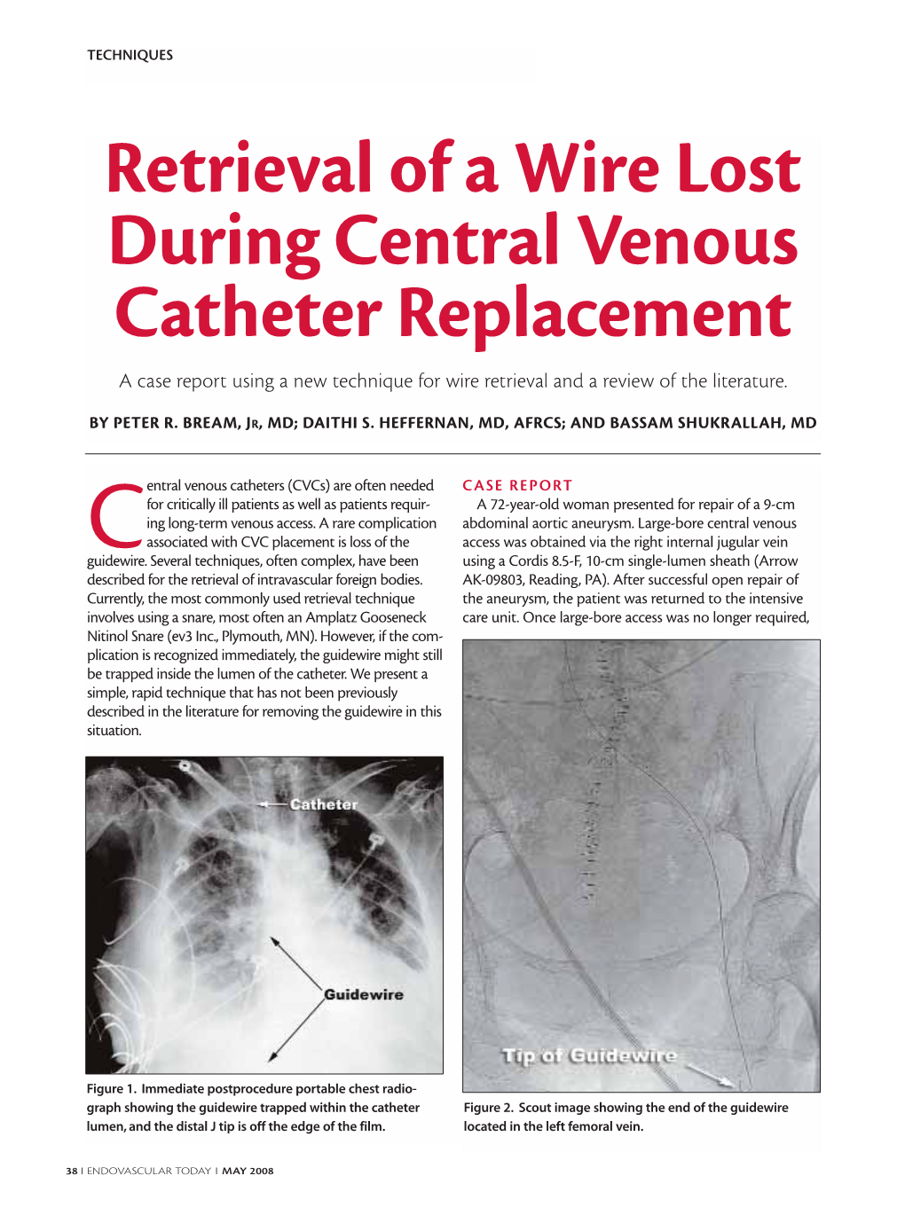 Retrieval of a Wire Lost During Central Venous Catheter Replacement a Case Report Using a New Technique for Wire Retrieval and a Review of the Literature