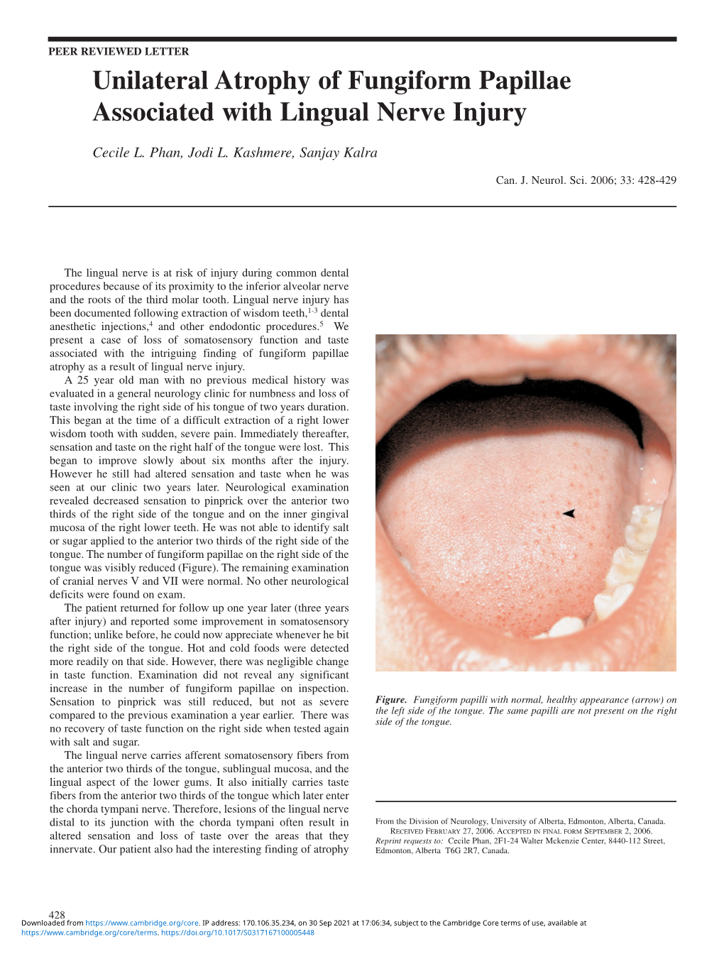 Unilateral Atrophy of Fungiform Papillae Associated with Lingual Nerve Injury