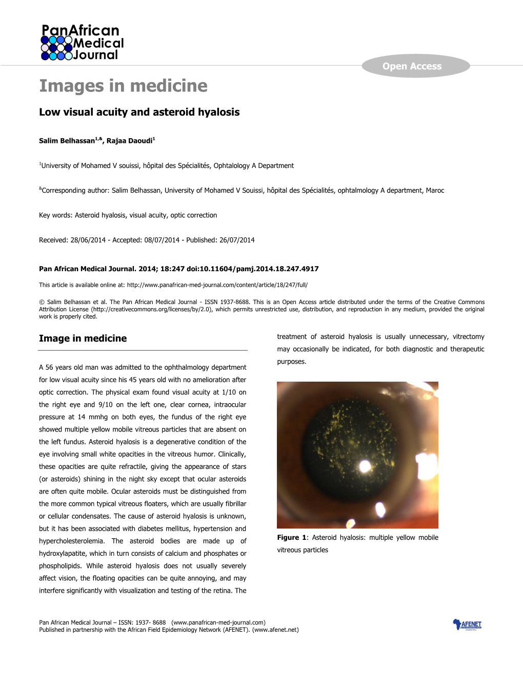 Low Visual Acuity and Asteroid Hyalosis