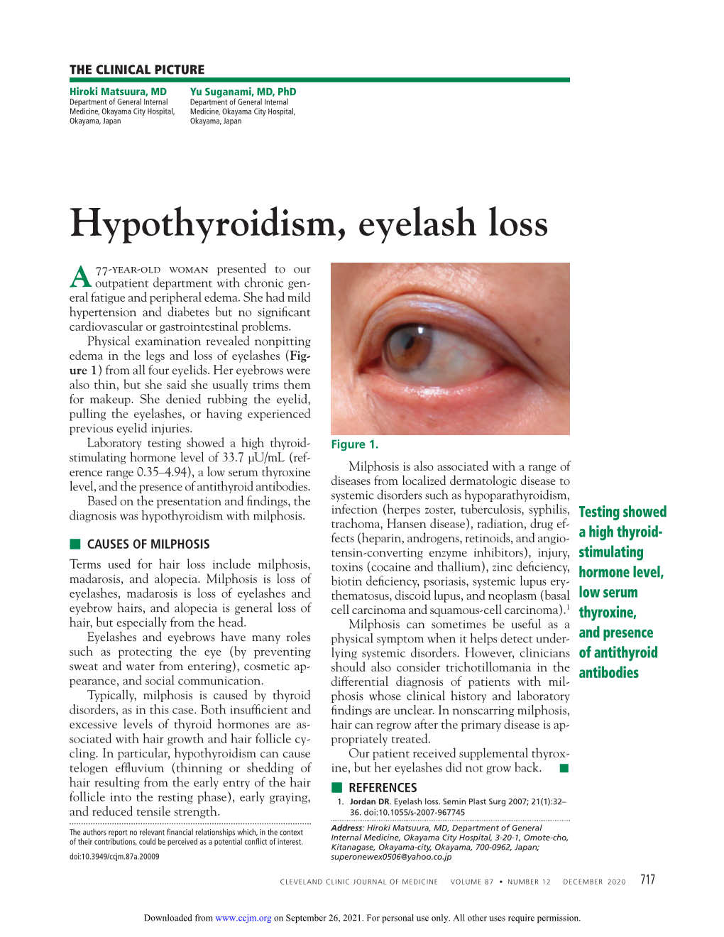 Hypothyroidism, Eyelash Loss