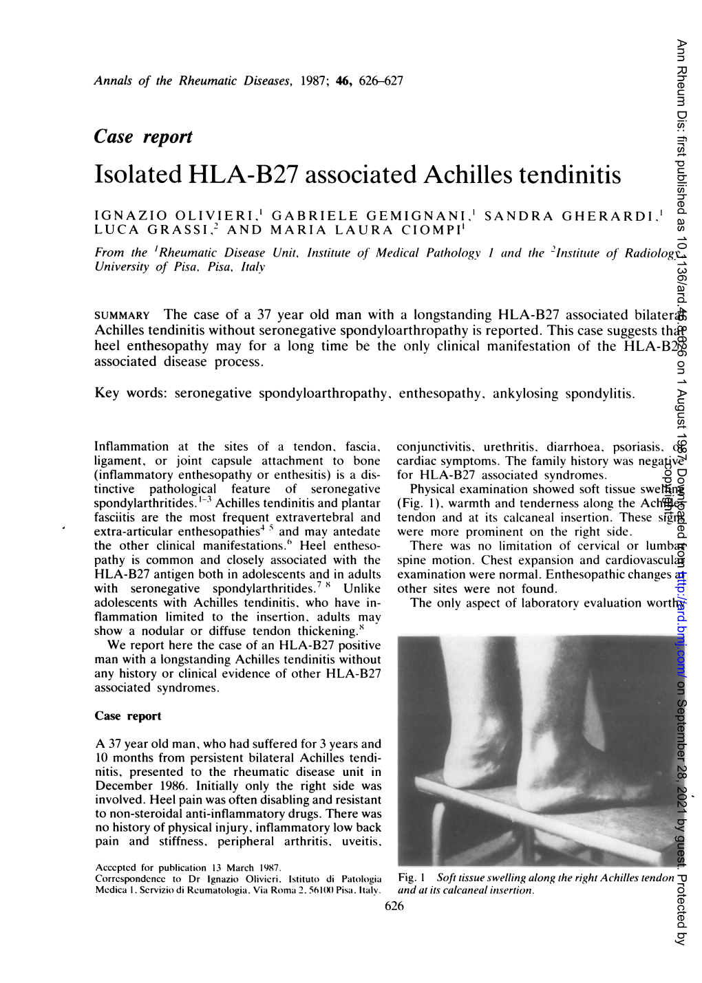 Isolated HLA-B27 Associated Achilles Tendinitis