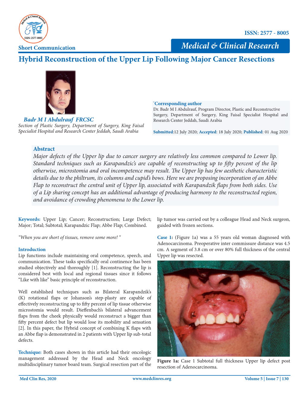 Hybrid Reconstruction of the Upper Lip Following Major Cancer Resections