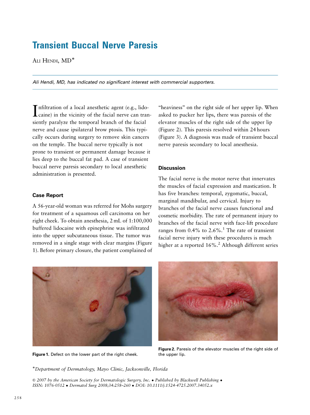 Transient Buccal Nerve Paresis Ã ALI HENDI,MD