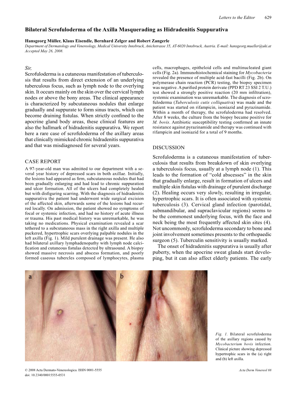 Bilateral Scrofuloderma of the Axilla Masquerading As Hidradenitis Suppurativa