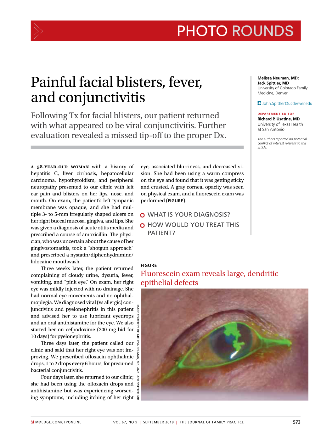 Painful Facial Blisters, Fever, and Conjunctivitis