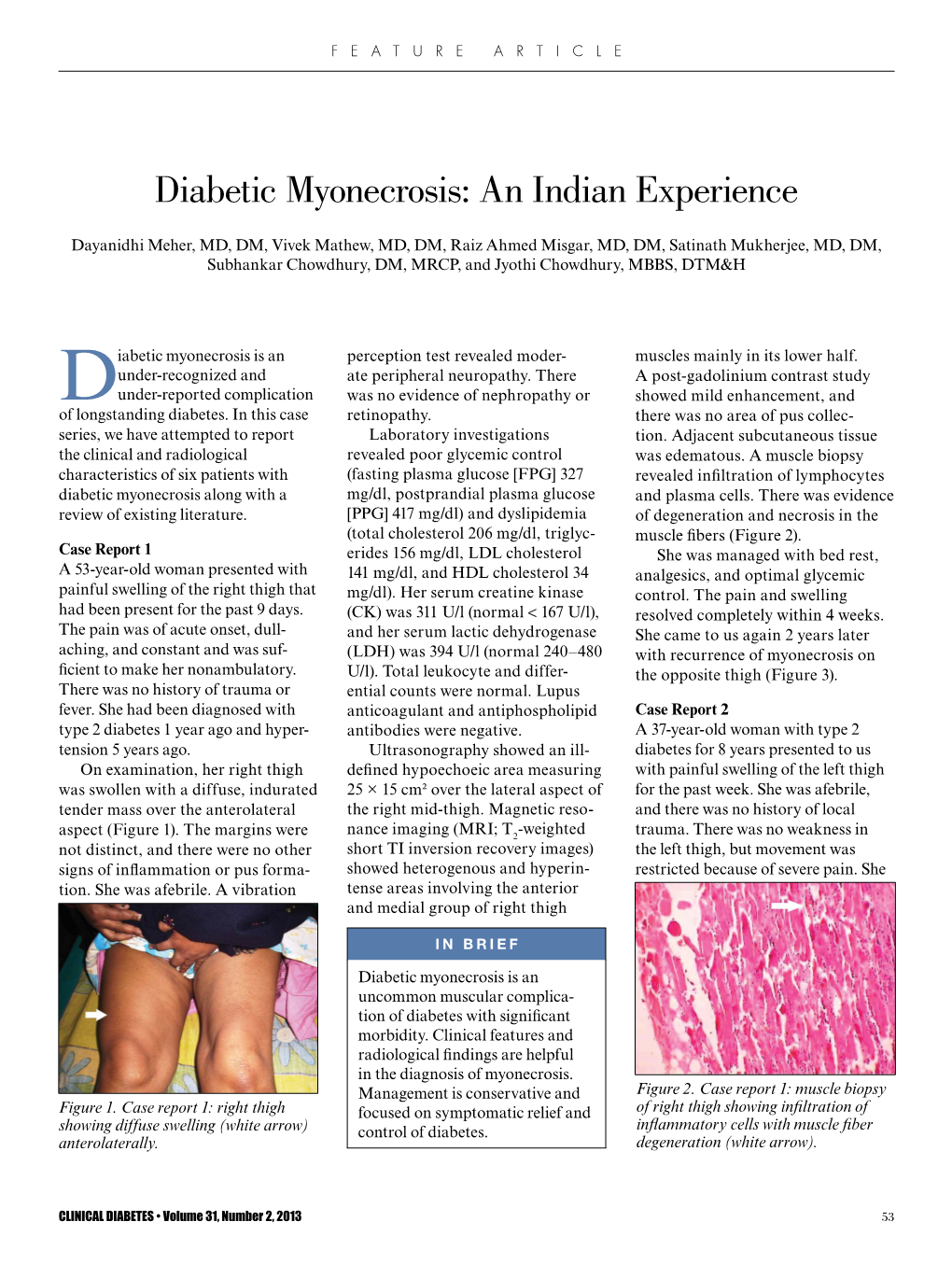 Diabetic Myonecrosis: an Indian Experience