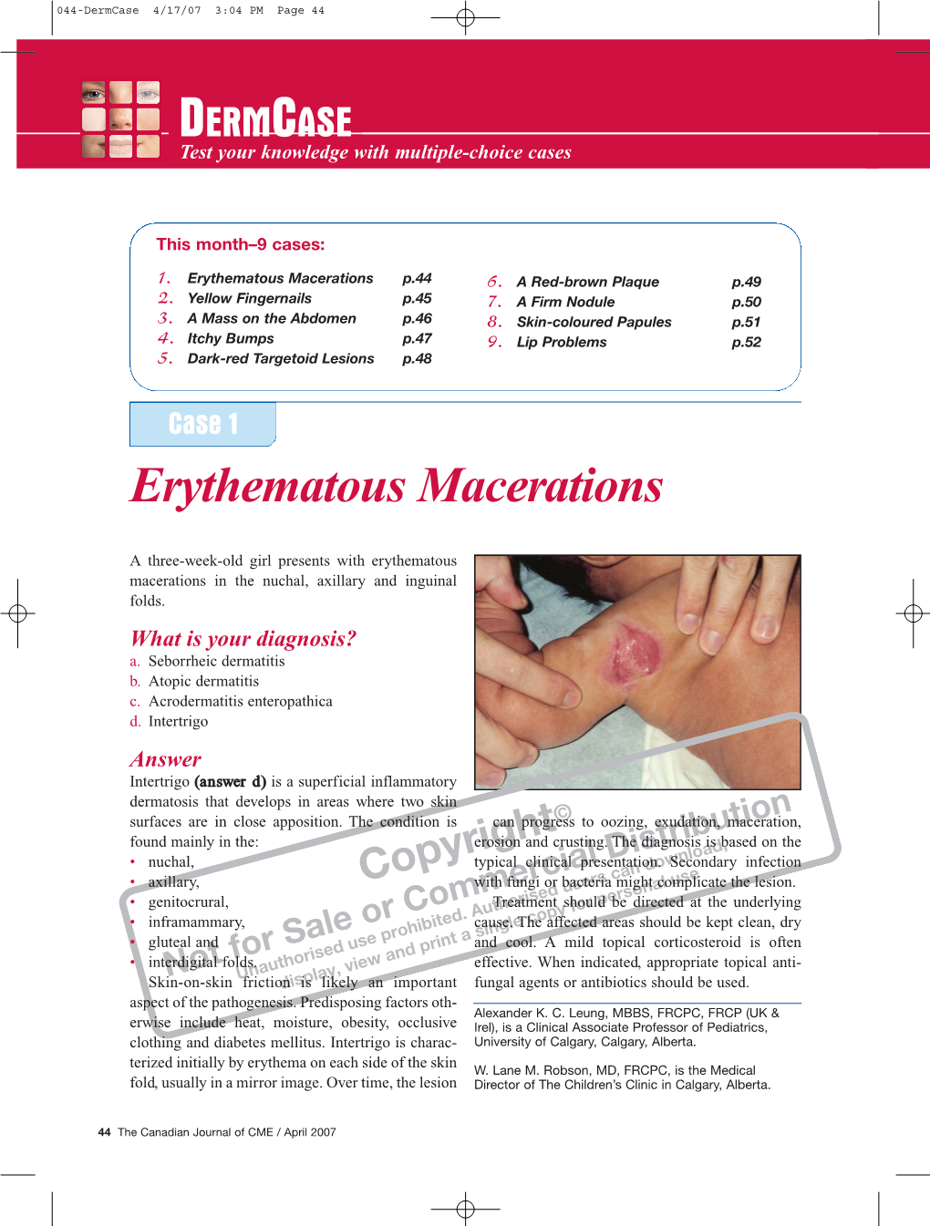 Erythematous Macerations P.44 6