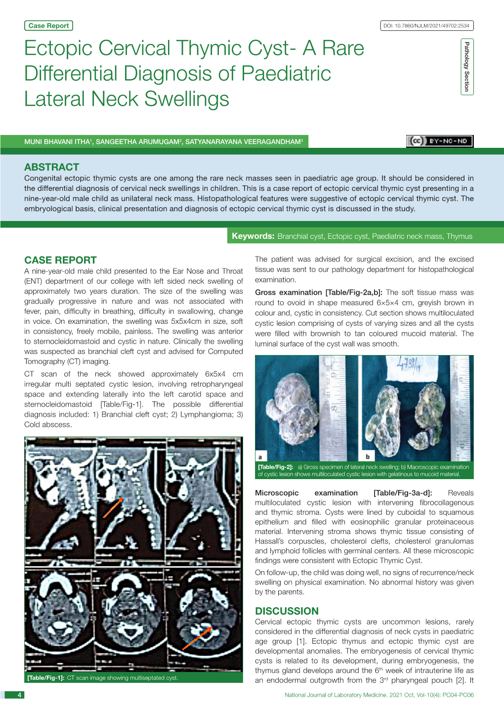 Ectopic Cervical Thymic Cyst- a Rare Pathology Section Differential Diagnosis of Paediatric Lateral Neck Swellings