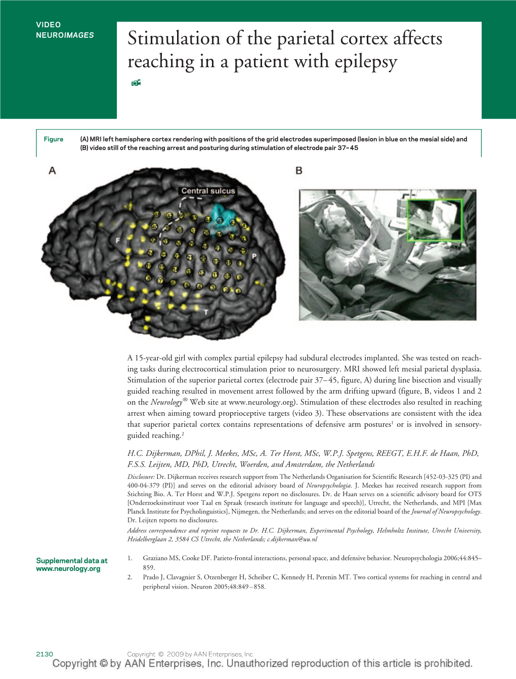 Stimulation of the Parietal Cortex Affects Reaching in a Patient with Epilepsy
