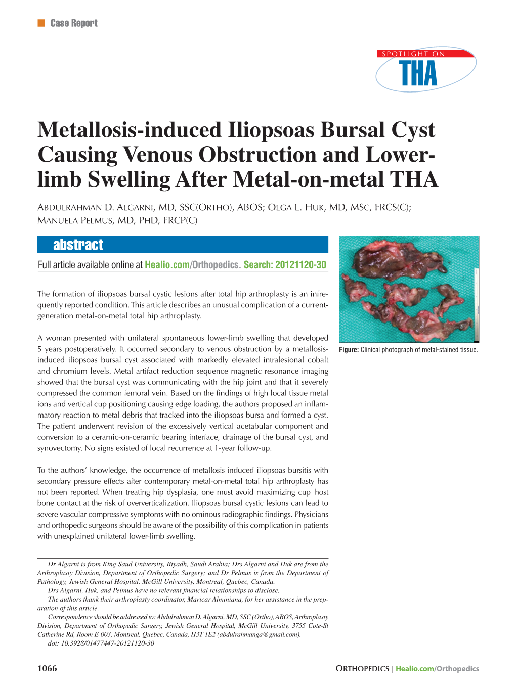 Metallosis-Induced Iliopsoas Bursal Cyst Causing Venous Obstruction and Lower- Limb Swelling After Metal-On-Metal THA