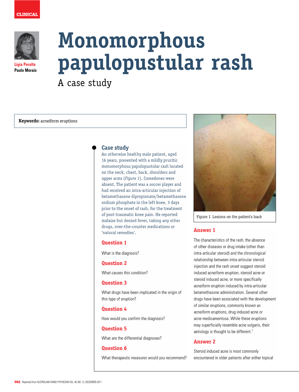Monomorphous Papulopustular Rash Located on the Neck, Chest, Back, Shoulders and Upper Arms (Figure 1)