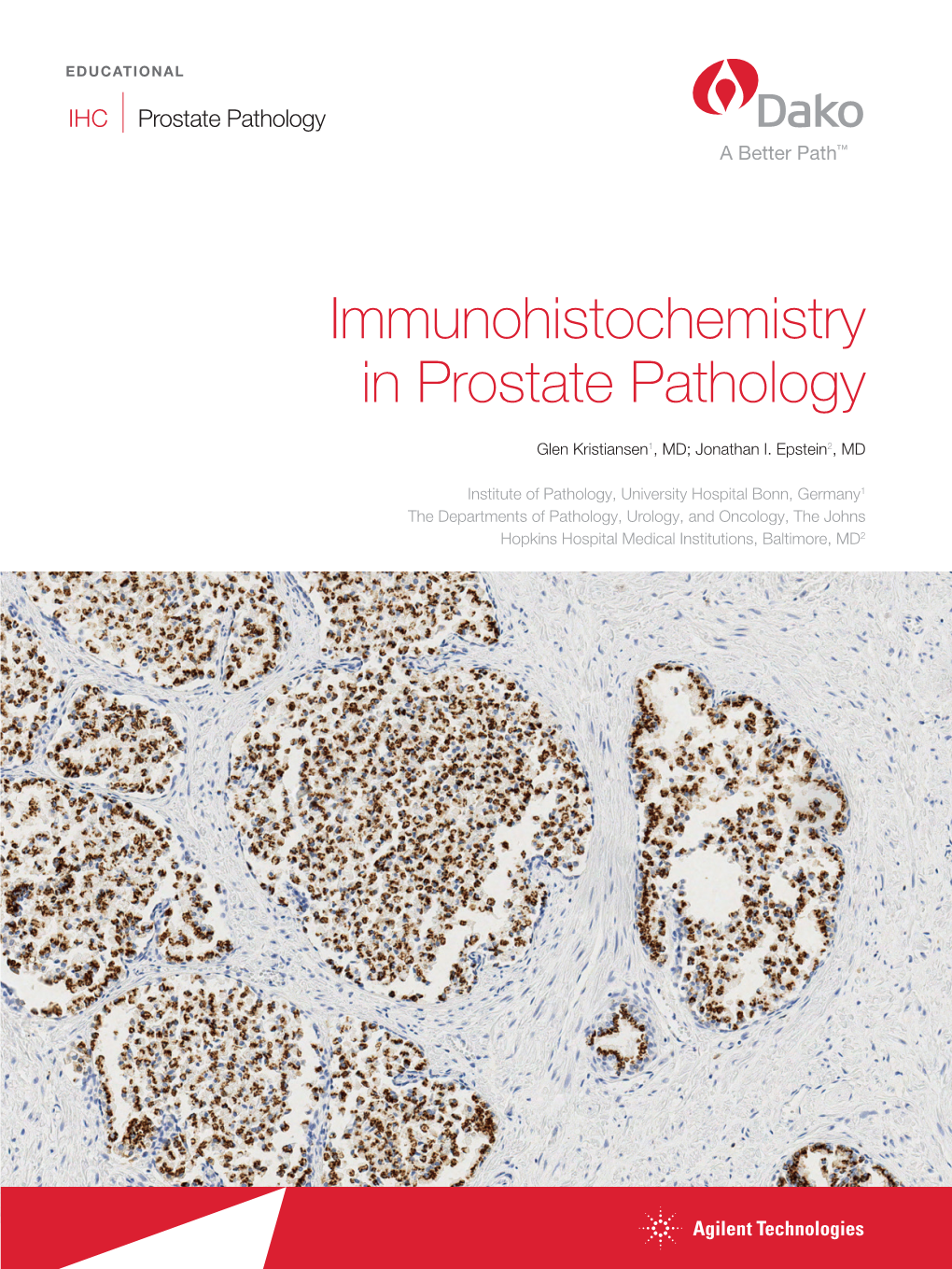 Immunohistochemistry in Prostate Pathology Review