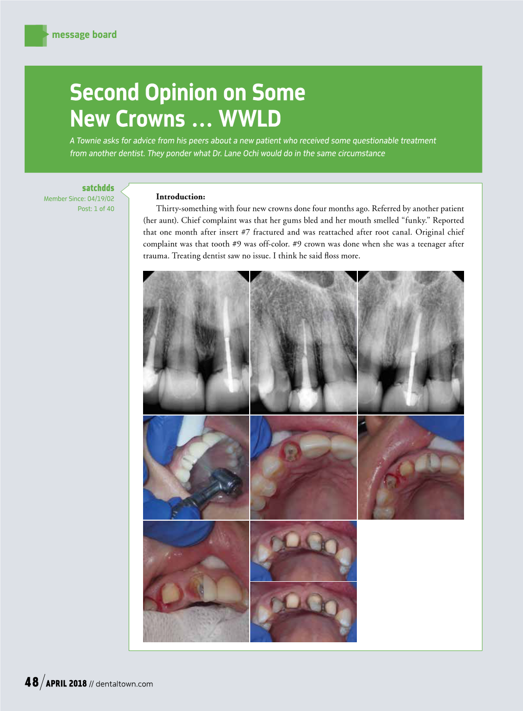 Second Opinion on Some New Crowns … WWLD a Townie Asks for Advice from His Peers About a New Patient Who Received Some Questionable Treatment from Another Dentist