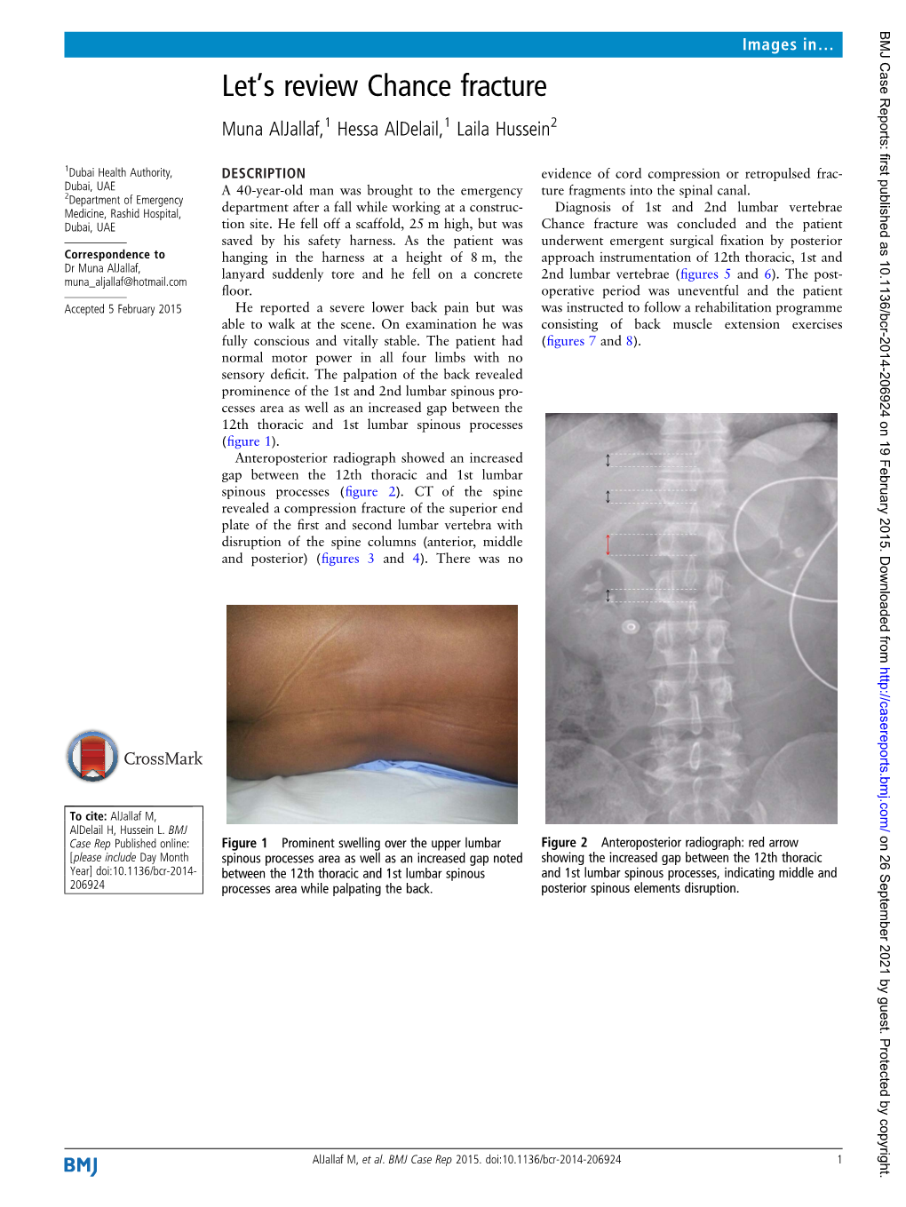 Let's Review Chance Fracture