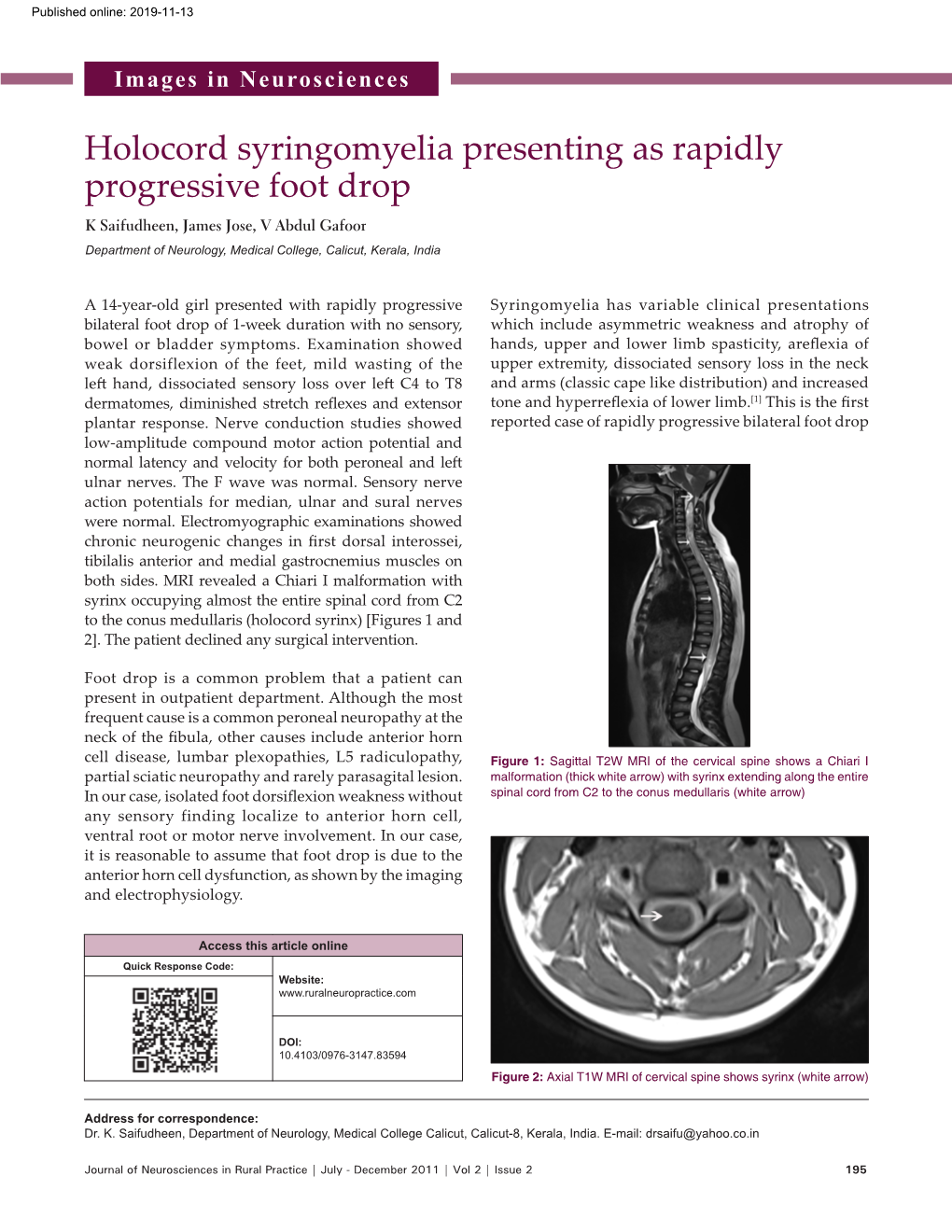 Holocord Syringomyelia Presenting As Rapidly Progressive Foot Drop
