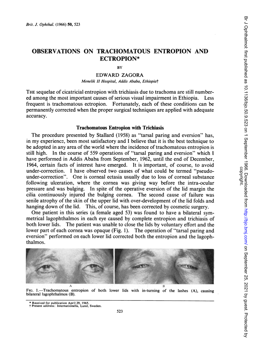 Observations on Trachomatous Entropion