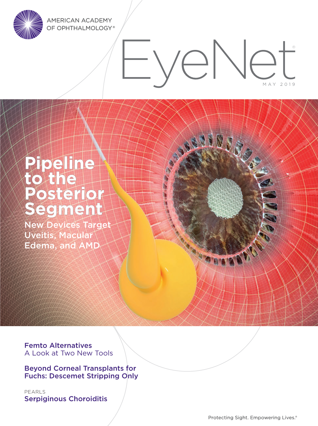 Pipeline to the Posterior Segment New Devices Target Uveitis, Macular Edema, and AMD