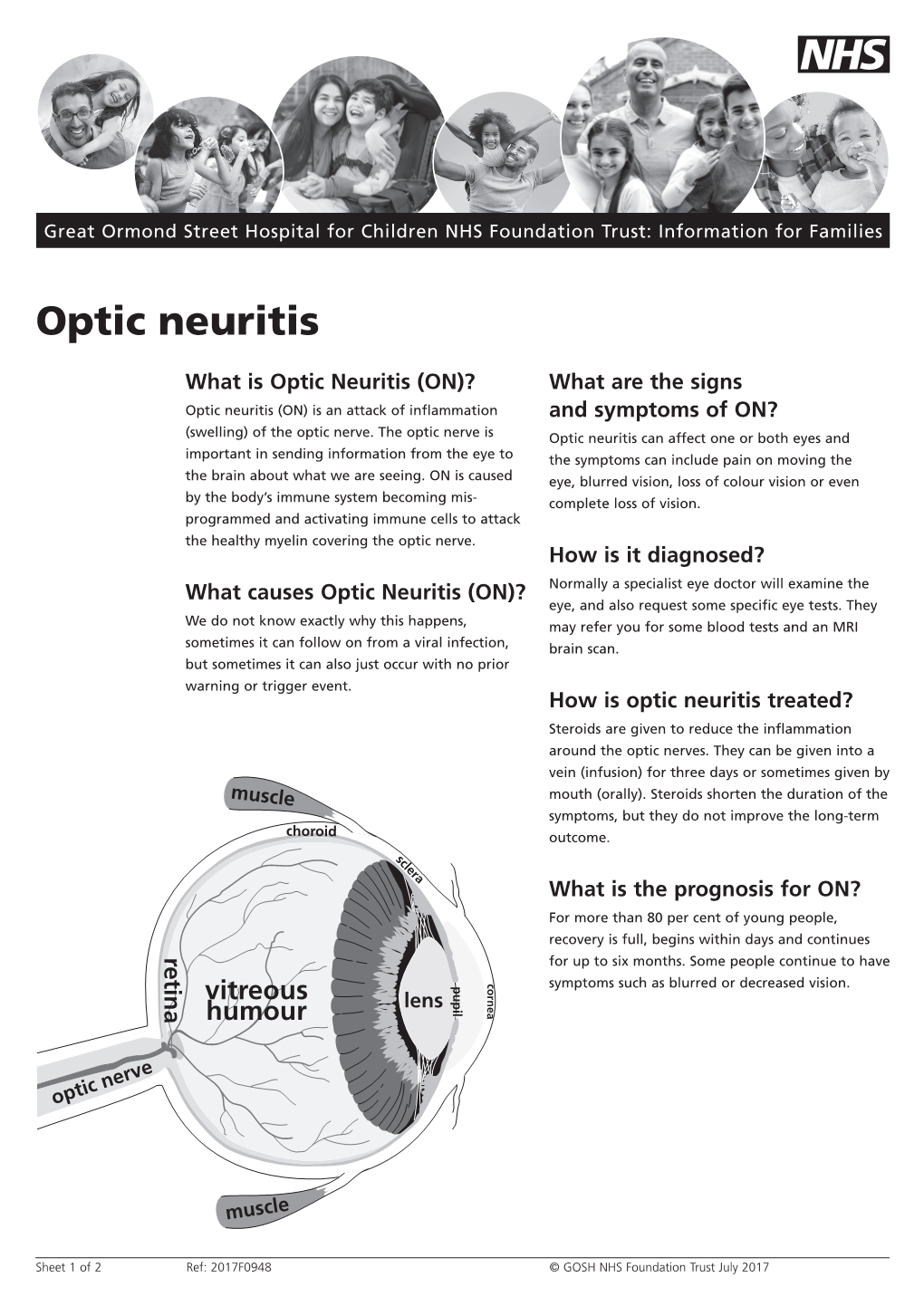 Optic Neuritis