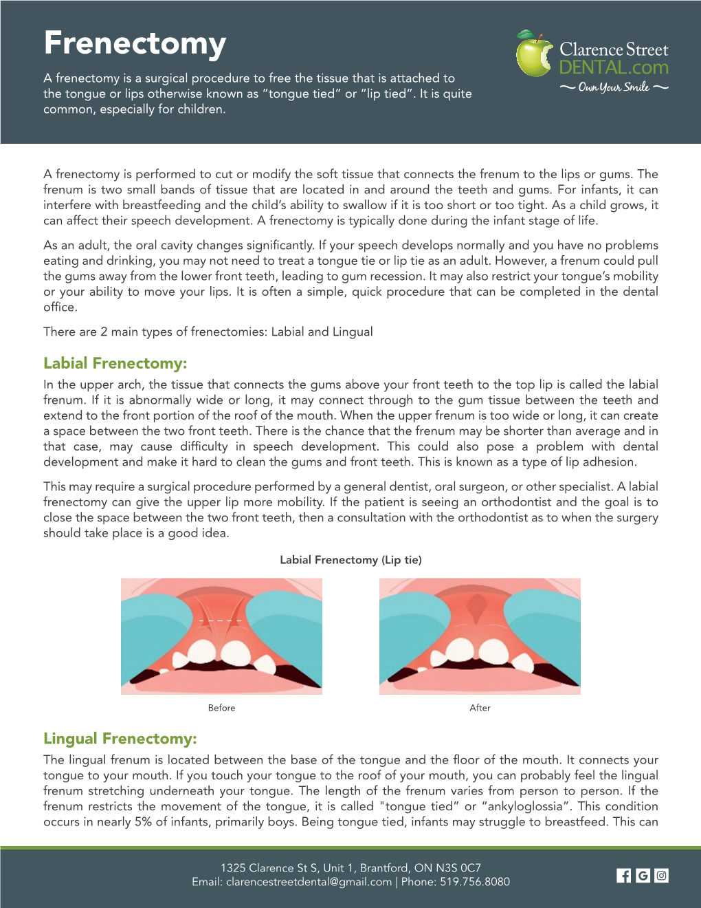Frenectomy a Frenectomy Is a Surgical Procedure to Free the Tissue That Is Attached to the Tongue Or Lips Otherwise Known As “Tongue Tied” Or “Lip Tied”