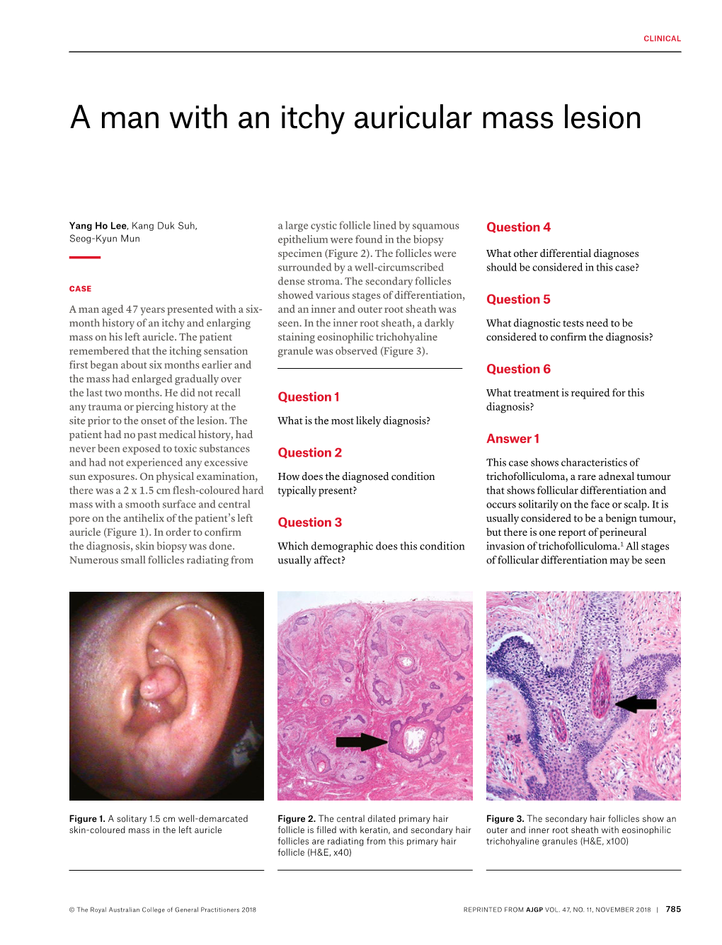 A Man with an Itchy Auricular Mass Lesion