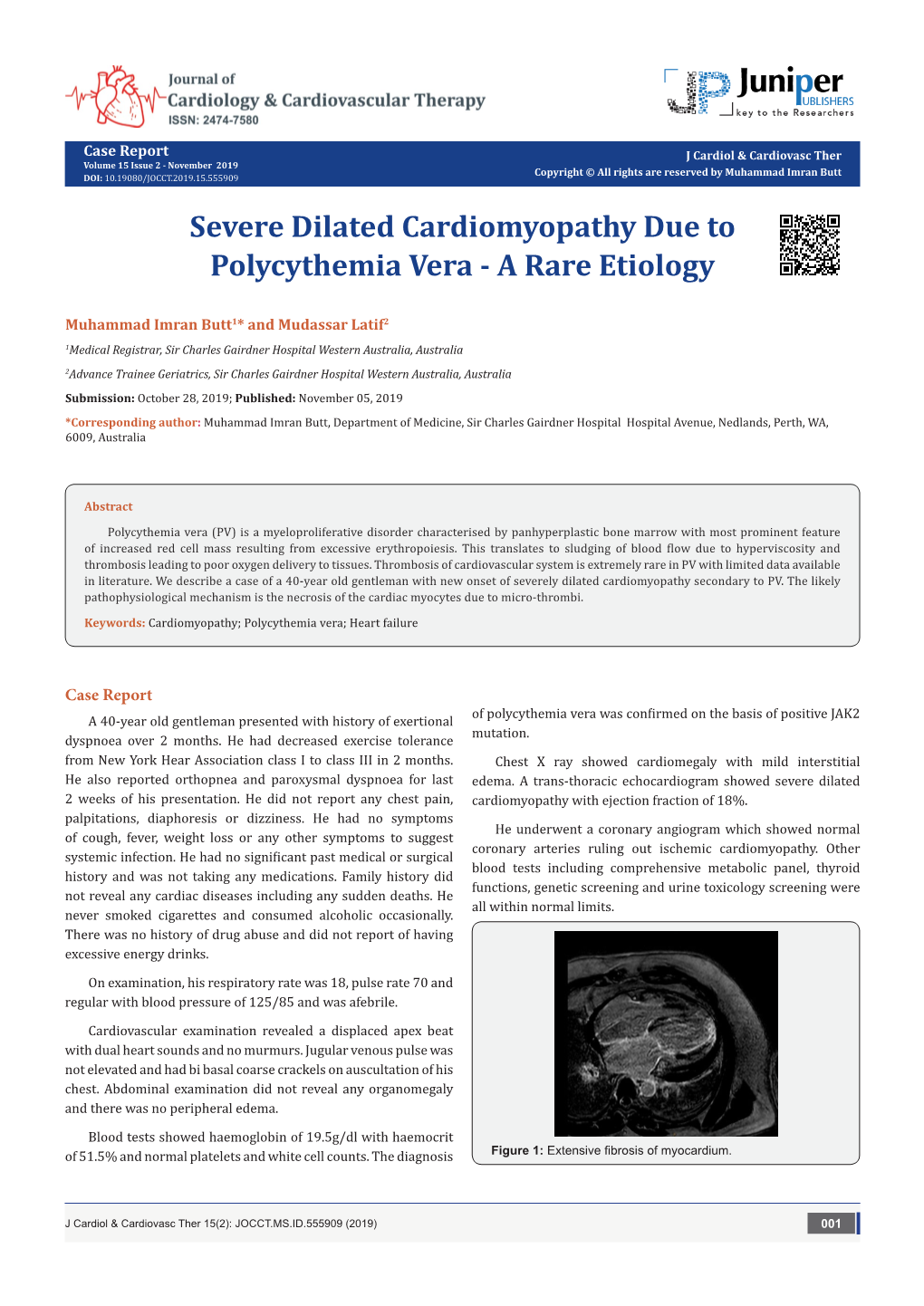 Severe Dilated Cardiomyopathy Due to Polycythemia Vera - a Rare Etiology