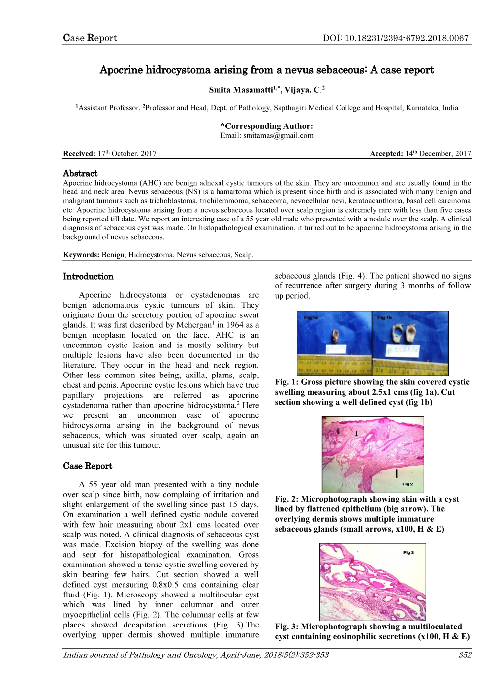 Apocrine Hidrocystoma Arising from a Nevus Sebaceous: a Case Report