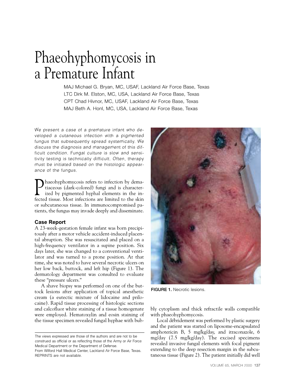 Phaeohyphomycosis in a Premature Infant MAJ Michael G