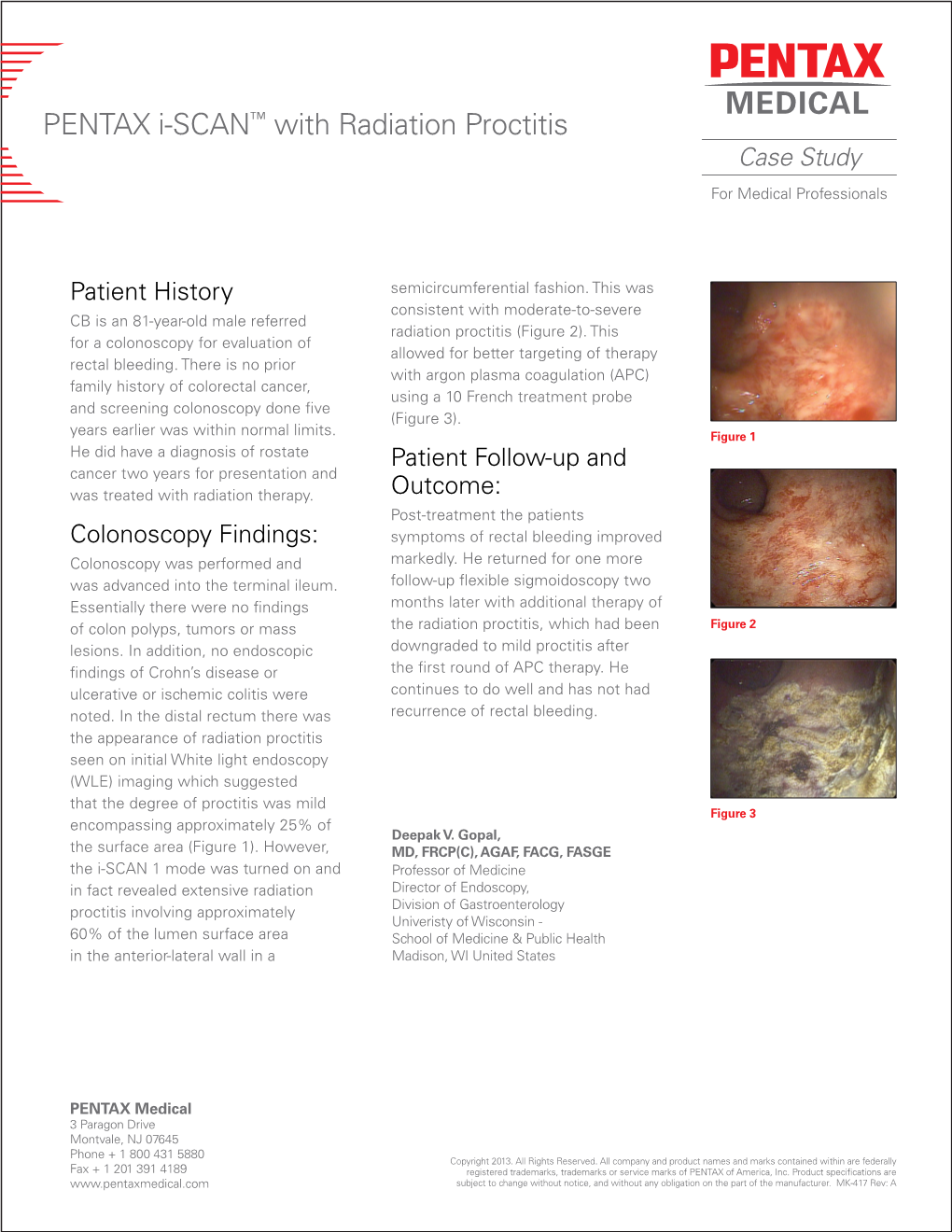 Radiation Proctitis Case Study for Medical Professionals