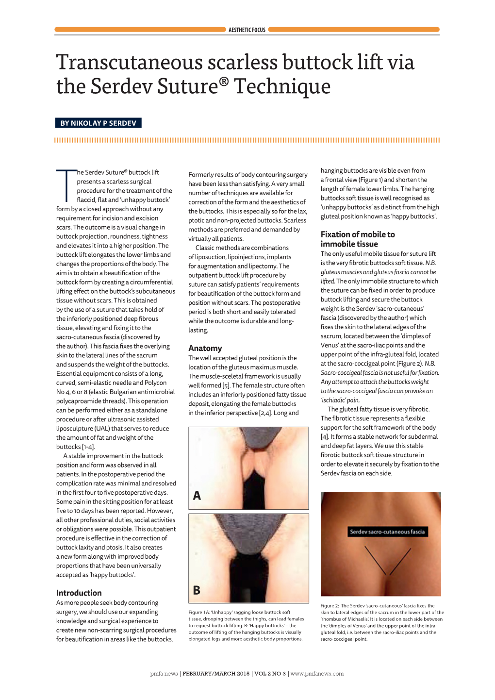 Transcutaneous Scarless Buttock Lift Via the Serdev Suture® Technique