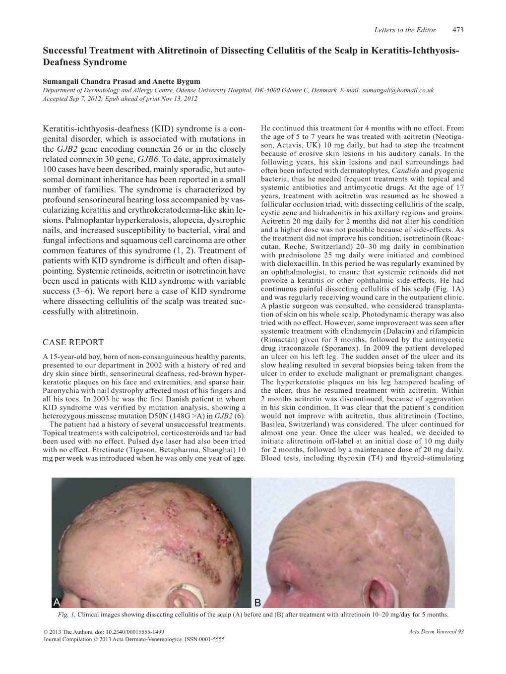 Successful Treatment with Alitretinoin of Dissecting Cellulitis of the Scalp in Keratitis-Ichthyosis- Deafness Syndrome