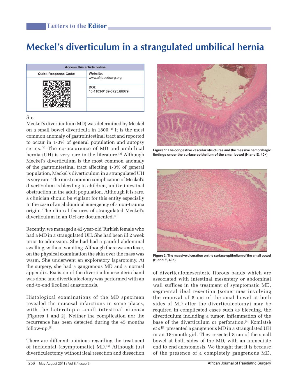 Meckel's Diverticulum in a Strangulated Umbilical Hernia