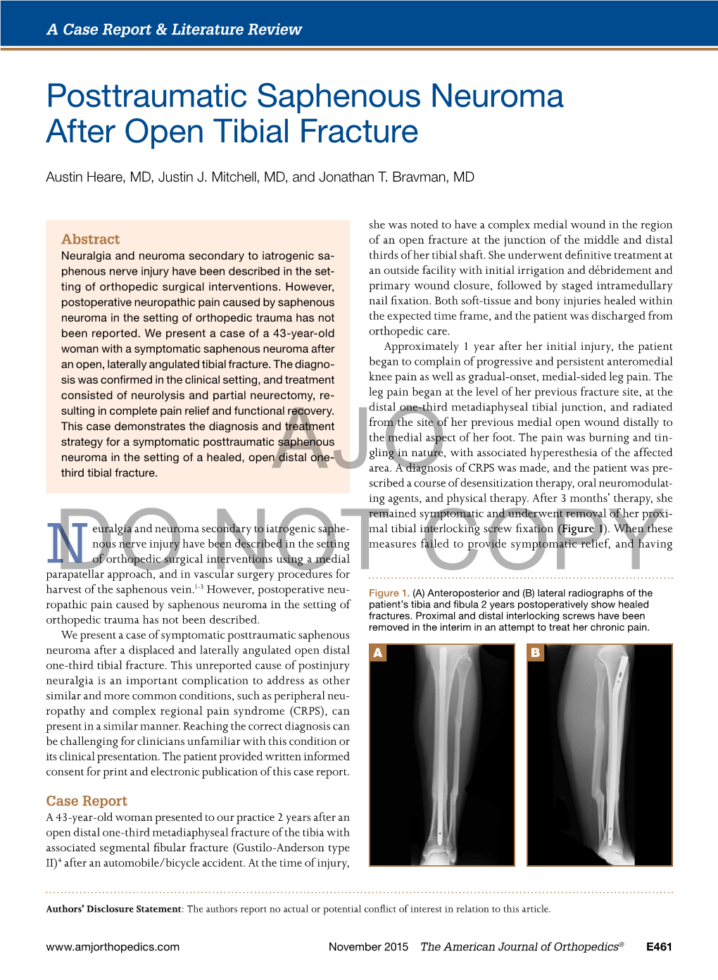 Posttraumatic Saphenous Neuroma After Open Tibial Fracture