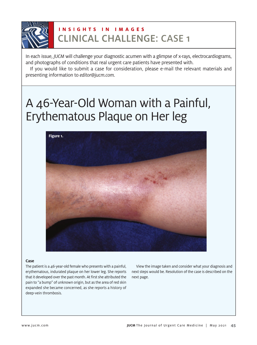 A 46-Year-Old Woman with a Painful, Erythematous Plaque on Her Leg