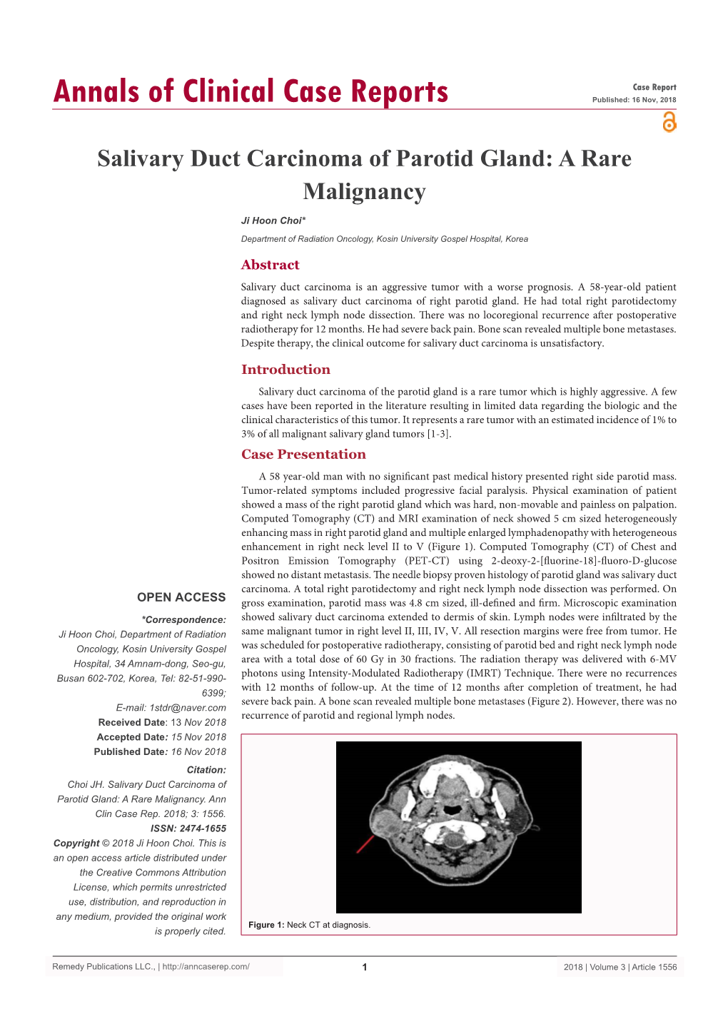 Salivary Duct Carcinoma of Parotid Gland: a Rare Malignancy