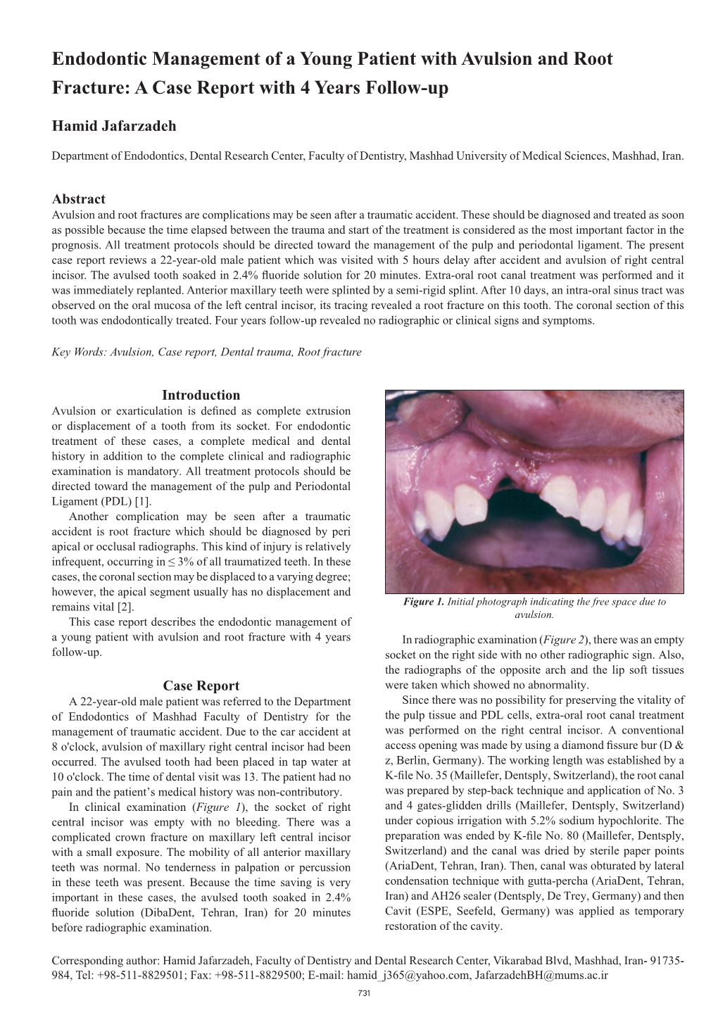 Endodontic Management of a Young Patient with Avulsion and Root Fracture: a Case Report with 4 Years Follow-Up