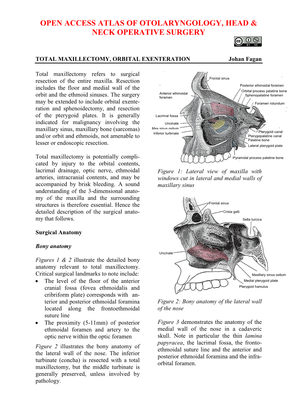 Total Maxillectomy and Orbital Exenteration