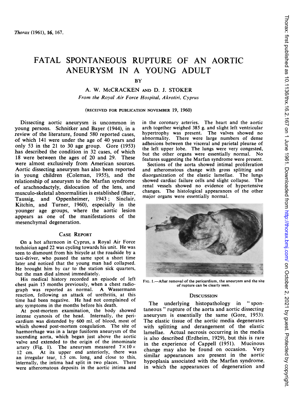 Fatal Spontaneous Rupture of an Aortic Aneurysm in a Young Adult by A